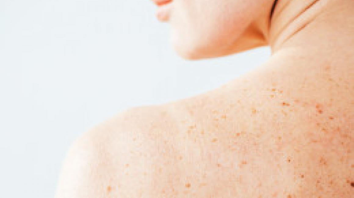 Program Profilaktyki Nowotworów Skóry