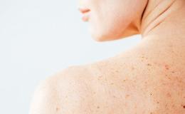 Program Profilaktyki Nowotworów Skóry